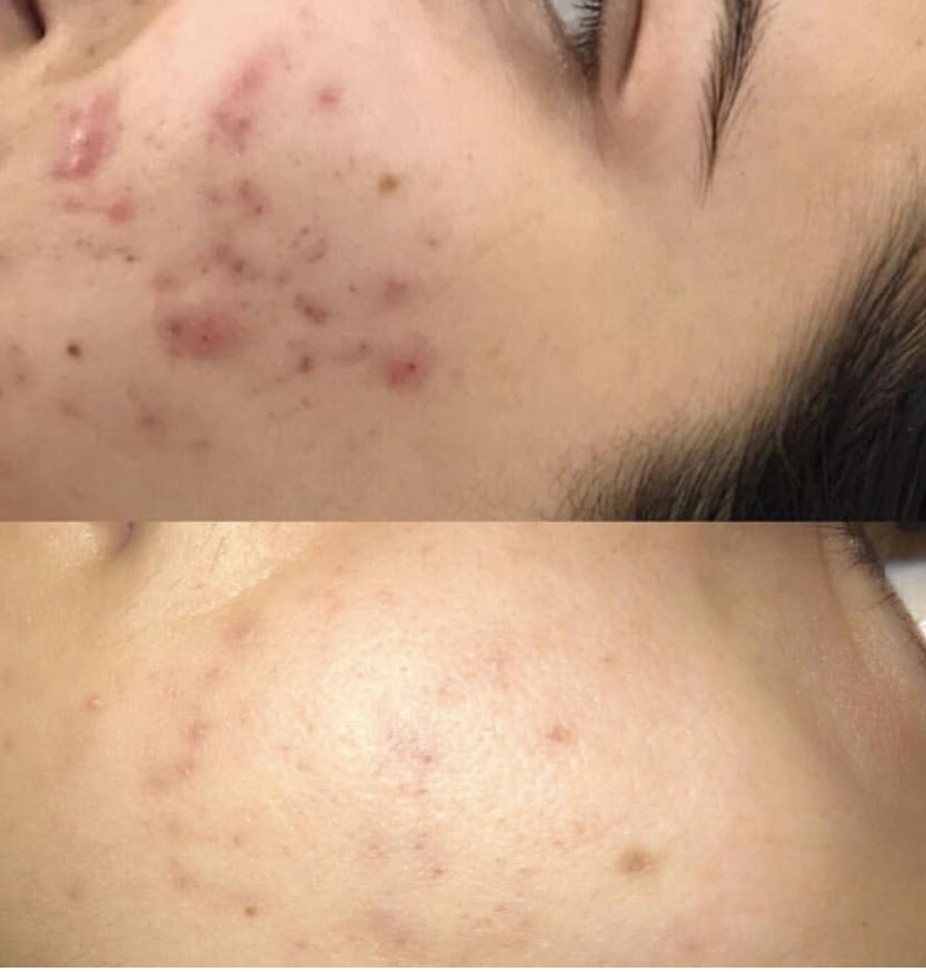 Tratamiento Facial Piel con Acné Elizabeth John